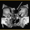 Casos clinicos-Patologias craneoencefalicas-encefalocele-frontonasal