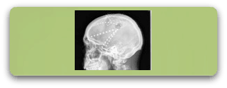 implantacion-electrodos-intracraneales-epilepsias-328x128-r-f1