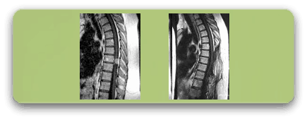 rm-dorsal-meningioma-pre-y-post-f1
