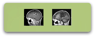 rm-glioma-parietal-izquierdo-f1