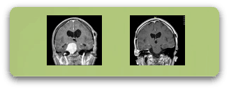 rm-meningioma-petroclival-antes-y-despues-cirugia-f1