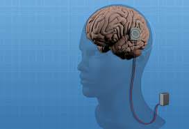implante-epilepsia