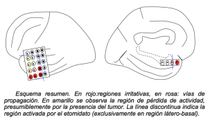 Oligodendroglioma en niña de 6 años Los tumores cerebrales en niños se localizan con más frecuencia en la fosa posterior.