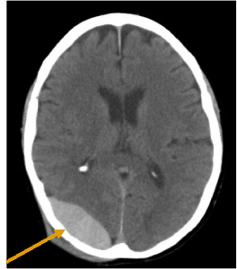 hamatoma-epidural Casos clinicos-patologia vascular-hematoma epidural occipital
