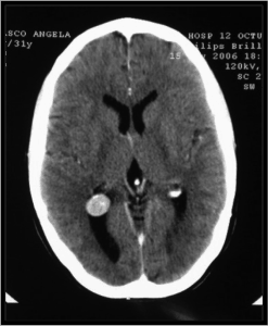 meningioma-intraventricular Los meningiomas son tumores benignos. La localización intraventricular es poco frecuente. Si alcanzan grandes tamaños pueden obstruir la circulación del líquido cefalorraquídeo provocando hidrocefalia.
